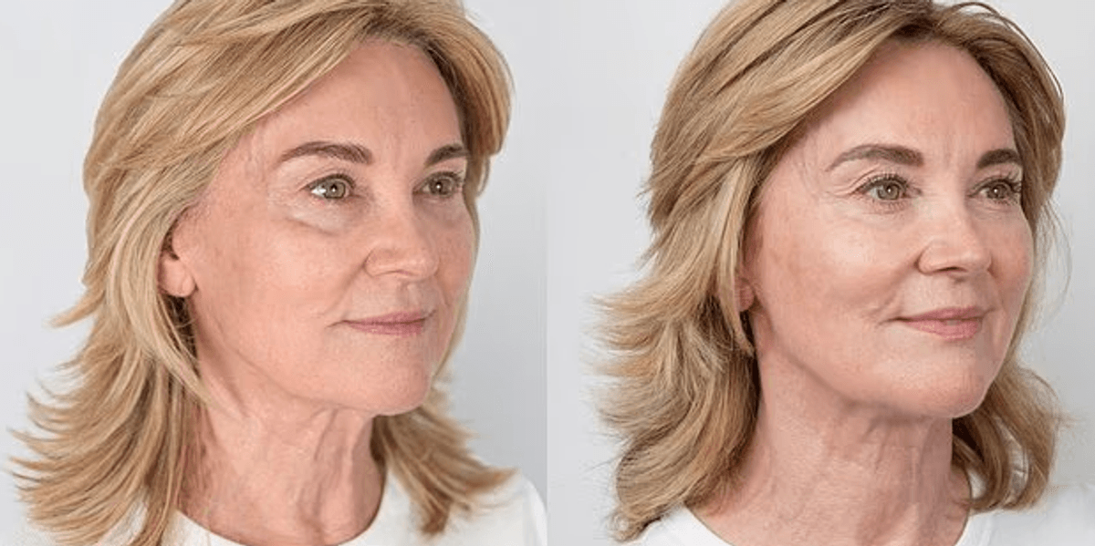 Anthea Turner tregon ndryshimin pas trajtimit jo kirurgjikal të fytyrës dhe qafës